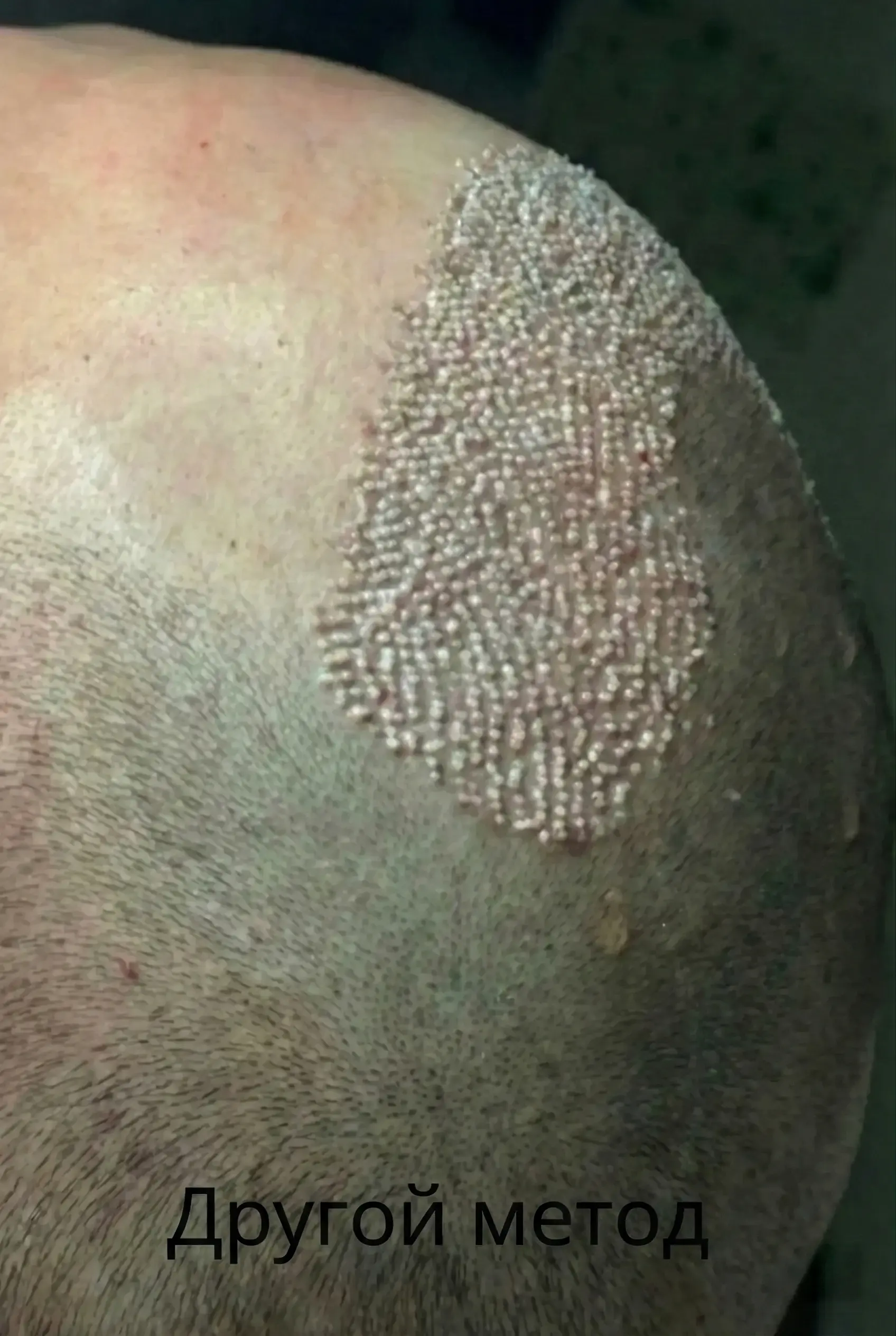 Traditional FUE hair transplant scarring example